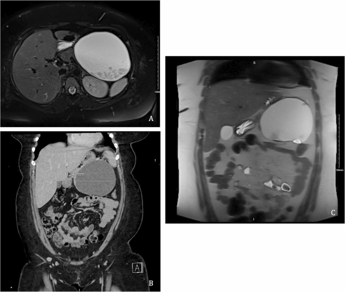 michigan glp-1 pancreatitis law office Pancreatic Mucinous Cystic Neoplasms Following GLP-1 Receptor Agonists Use:  A Report of Two Cases with Literature Review | Journal of Gastrointestinal  Cancer