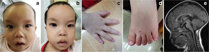 Clinical exome sequencing identifies novel CREBBP variants in 18 Chinese  Rubinstein–Taybi Syndrome kids with high frequency of polydactyly - Yu -  2019 - Molecular Genetics & Genomic Medicine - Wiley Online Library