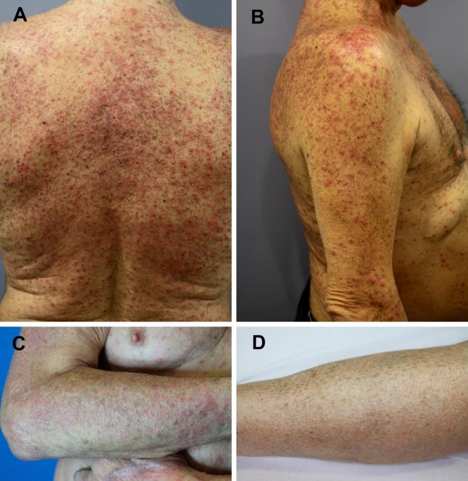 Early Lapatinib-Induced Skin Rash Predicts Better Survival With  Lapatinib+Trastuzumab Therapy - Cancer Therapy Advisor