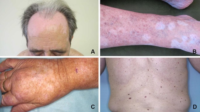 Early Lapatinib-Induced Skin Rash Predicts Better Survival With  Lapatinib+Trastuzumab Therapy - Cancer Therapy Advisor