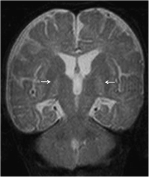MRI Findings in Kernicterus | Indian Journal of Pediatrics