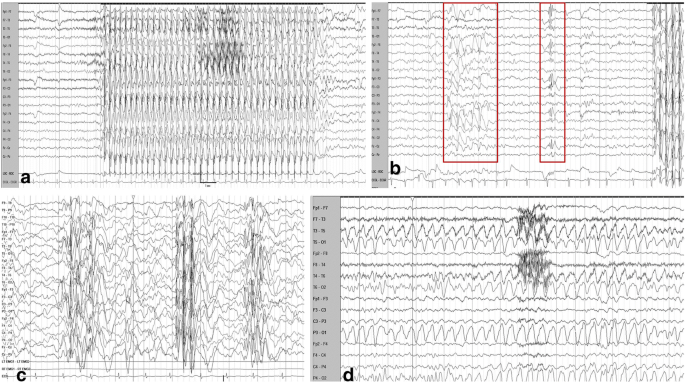 Absence Seizures In Children Usual And