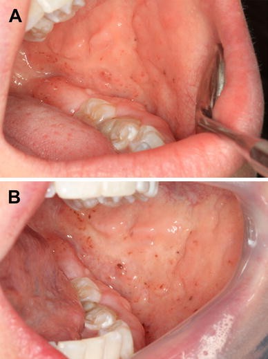melanotic nevus oral Oral Congenital Melanocytic Nevus: A Rare Case Report and Review of the  Literature | Head and Neck Pathology
