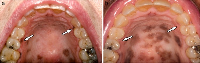 melanotic macule roof of mouth An oral is a harmless dark spot found on the lip, most often the lower lip, or inside the mouth, either on the gums, inside the cheek, or on the the mouth. An oral melanotic Oral pigmented lesions: Clinicopathologic features