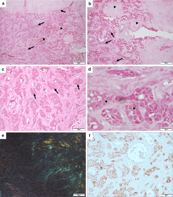 Synchronous Calcifying Epithelial Odontogenic Tumor: Case Report and  Analysis of the 5 Cases in the Literature | Head and Neck Pathology