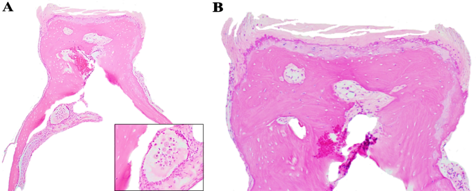 The Stapes in Otosclerosis: Osteoarthritis of an Ear Ossicle