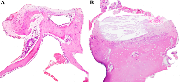 The Stapes in Otosclerosis: Osteoarthritis of an Ear Ossicle