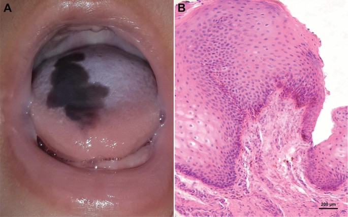congenital lingual melanotic macules Congenital Melanotic Macule of the Tongue: Report of Two Cases and  Literature Review | Head and Neck Pathology