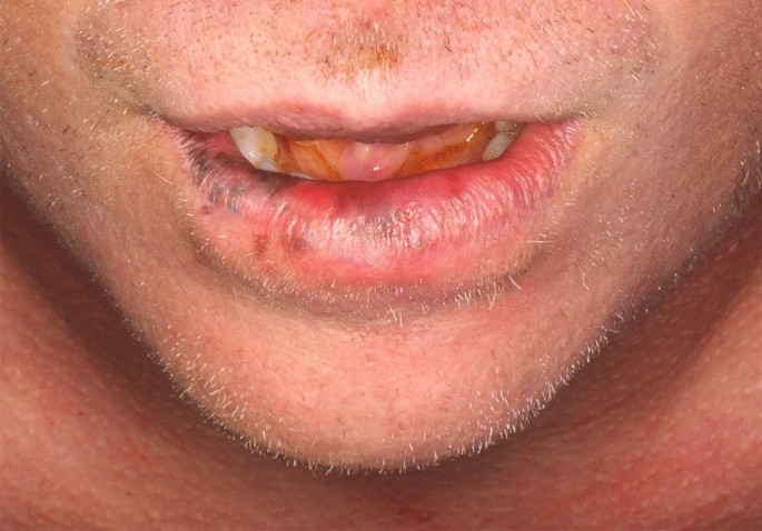 melanotic in situ Melanoma with Ulcer Melanoma in Situ  What