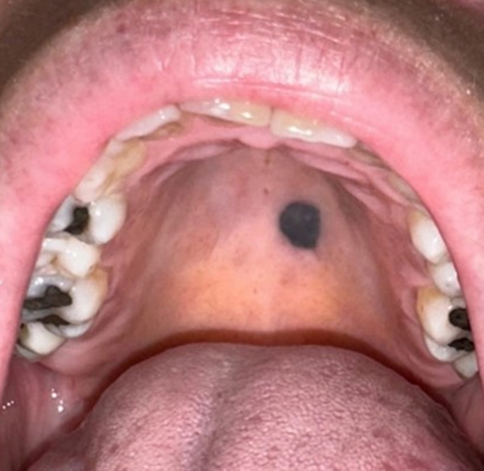 melanotic nevus oral Blue Nevus of The Palate: A Case Image | Head and Neck Pathology