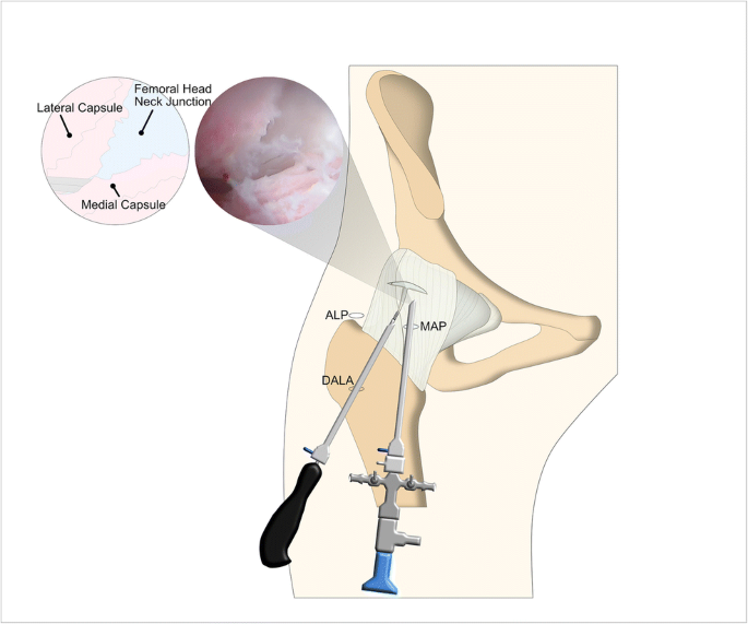 Contemporary Management of the Hip Capsule During Arthroscopic Hip