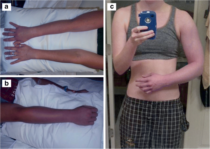 Thoracic Outlet Compression Syndrome and Its Surgical Treatment Modalities