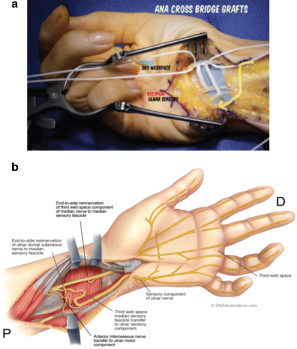 Severe Cubital Tunnel Syndrome: Considerations for Nerve Transfer