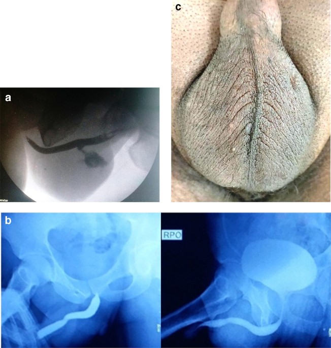 Vasectomy Causing Urethrocutaneous Fistula: a Rare Complication | Indian  Journal of Surgery