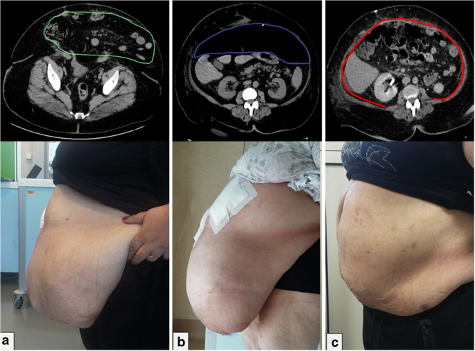 can bpc 157 heal hernia Abeezar Sarela| Umbilical Hernia| Para-Umbilical Synchronous Surgical Treatment of Morbid