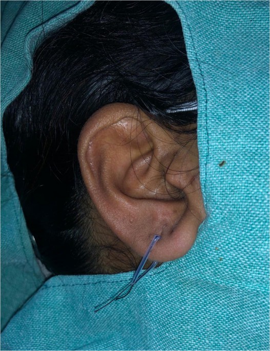 Ear Piercing—a Simple Solution | Indian Journal of Surgery