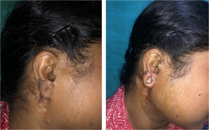 Ear Piercing—a Simple Solution | Indian Journal of Surgery