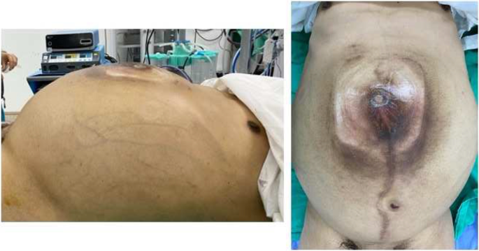 Intraperitoneal rupture of the hydatid cyst: Four case reports and