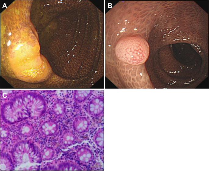 melanotic mucosa colon Melanosis Coli Classification of melanosis coli (MC)