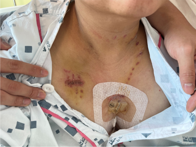 Modified Technique of Chemoport Placement in Severely Obese Patient for  Administration of Chemotherapy