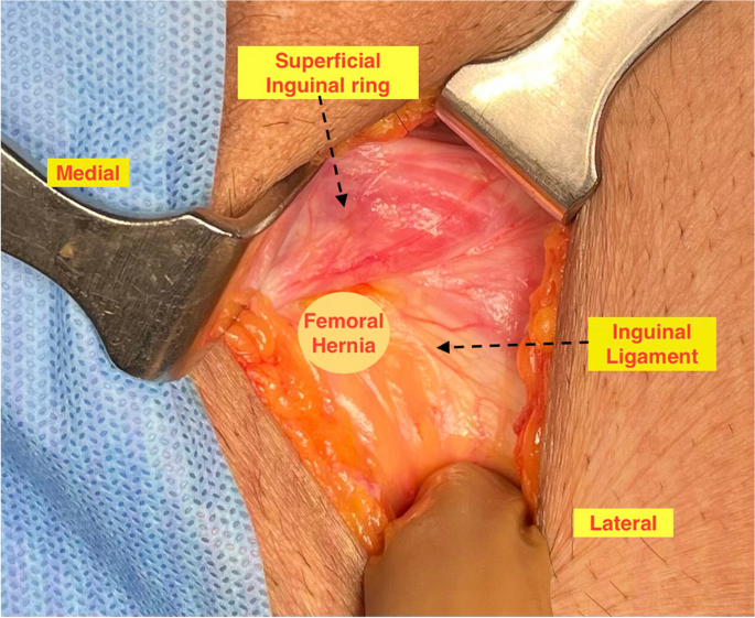 Femoral Hernia—A New Surgical Technique for Open Repair