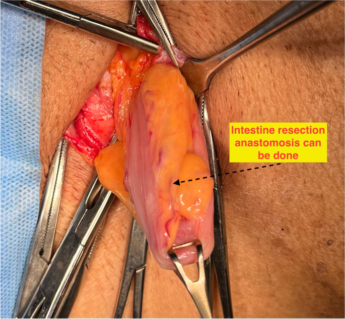 Open femoral hernia repair: one skin incision for all
