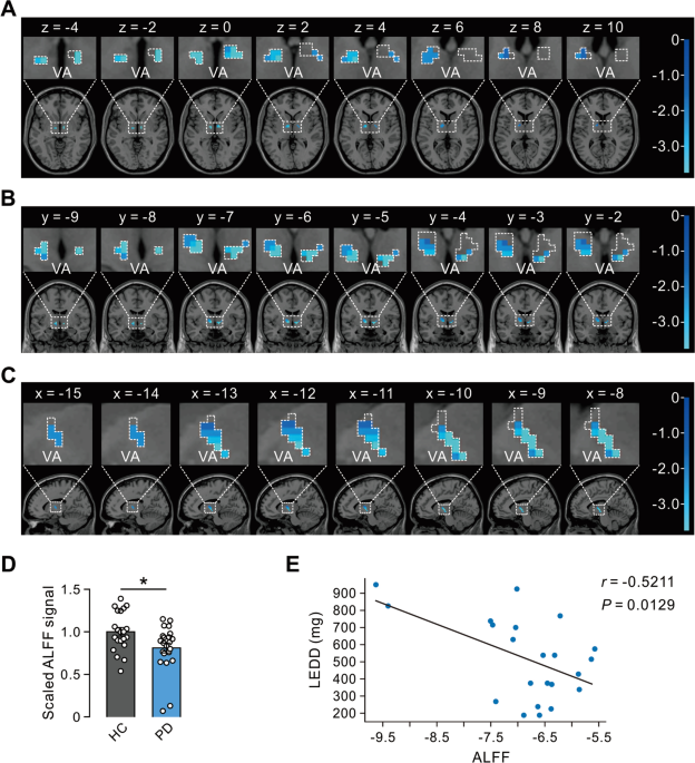 Histaminergic Innervation of the Ventral Anterior Thalamic Nucleus Alleviates Motor Deficits in a 6-OHDA-Induced Rat Model of Parkinson’s Disease