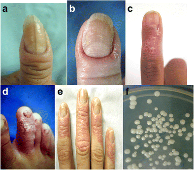 Nail Diseases Flashcards | Quizlet