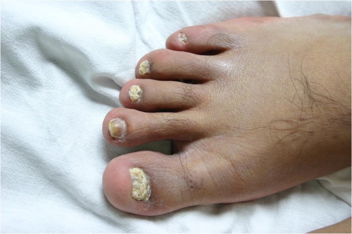 Candidiasis of the Skin and Nails - StoryMD