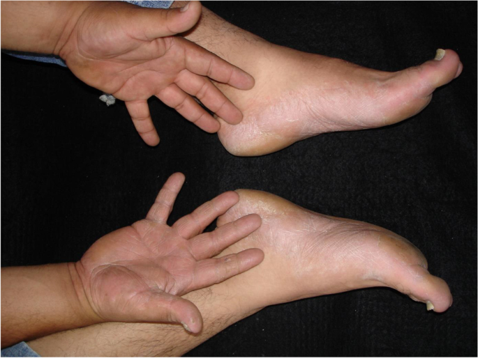 Two Feet-One Hand Syndrome: Tinea Pedis and Tinea Manuum