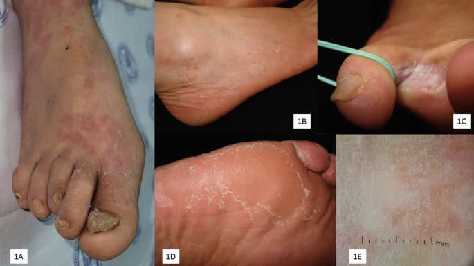 A case of tinea manuum and tinea pedis showing involvement of one