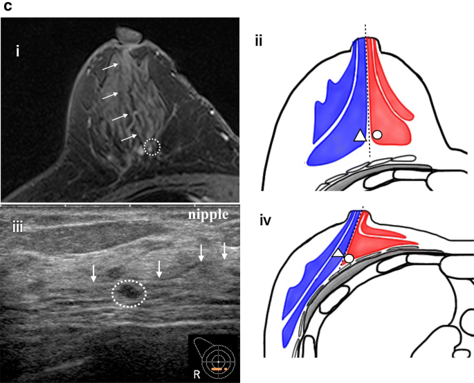 Findings of the right nipple; ultrasound and MR images of the breast. a