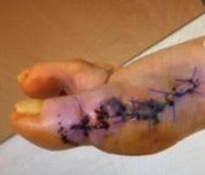 Nylon sutures versus skin staples in foot and ankle surgery: is