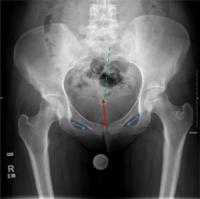 Assessment of the young adult hip joint using plain radiographs |  MUSCULOSKELETAL SURGERY