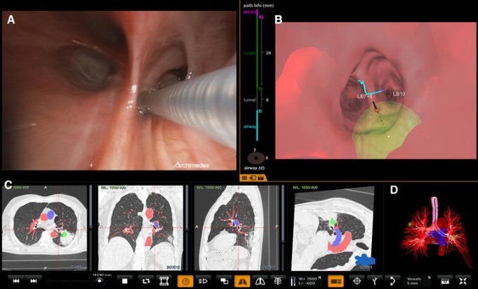 Navigational Bronchoscopy for Early Lung Cancer: A Road to Therapy |  Advances in Therapy