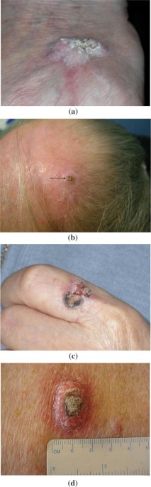 Cutaneous Disorders of the Breast