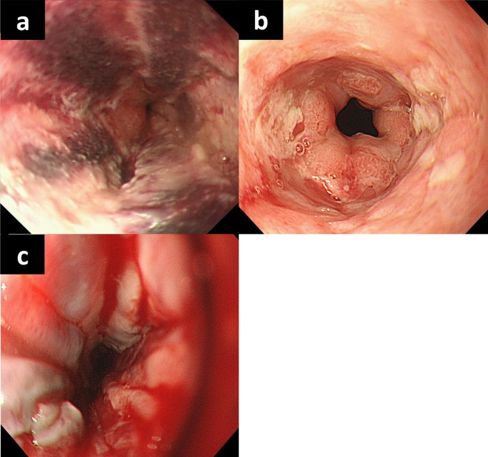 Two cases of esophageal ulcer after surgical treatment for ulcerative  colitis | Clinical Journal of Gastroenterology