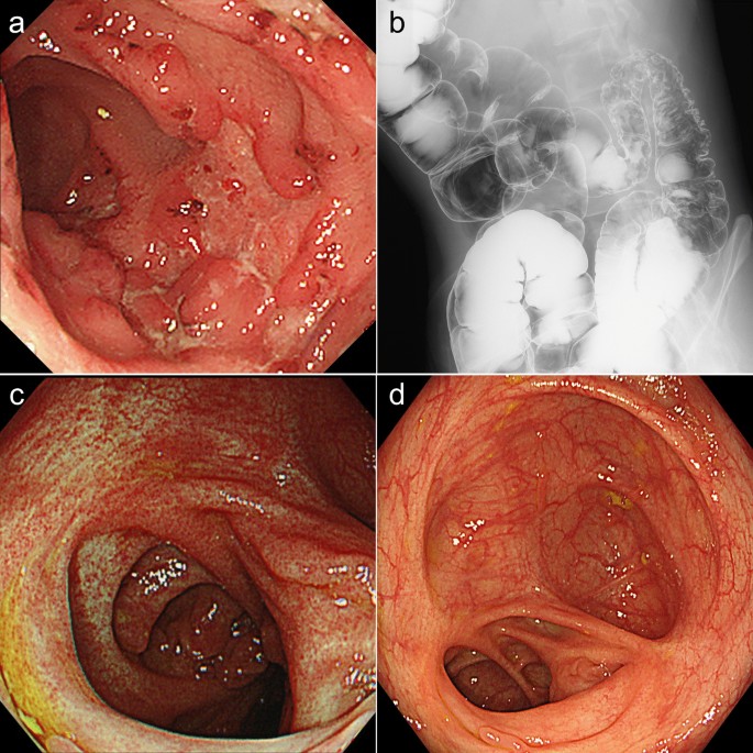 bpc-157 crohn's disease reddit Long-term endoscopic remission in after allogeneic hematopoietic stem cell transplantation for diffuse large B cell lymphoma: case report and literature review | Clinical Journal of Gastroenterology Dosage:15mg (pro) Doubling Semaglutide Dose Helps peptide skincare