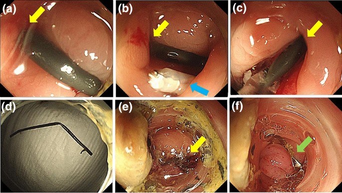 Successful endoscopic closure with an over-the-scope clip for sigmoid colon  perforation due to bile duct stent migration