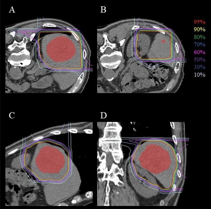 Long-term survivor of hepatocellular carcinoma treated with repeated carbon  ion radiotherapy and transarterial chemoembolization: a case report |  Clinical Journal of Gastroenterology