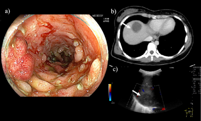 Successful transition to mirikizumab following hepatic abscess during adalimumab therapy in a patient with ulcerative colitis