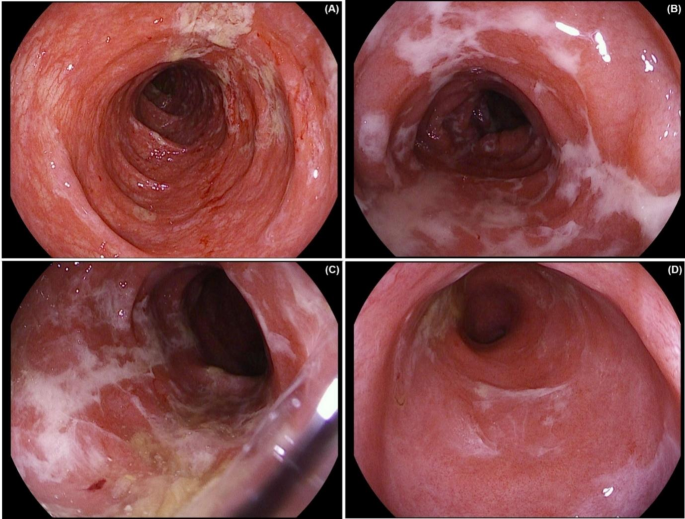 Flucytosine-induced colitis mimicking a flare of ulcerative colitis: a diagnostic challenge in pulmonary cryptococcal infection