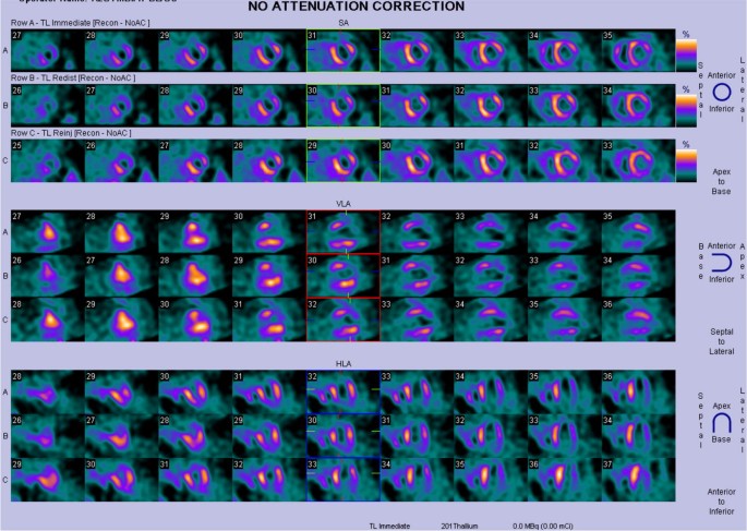 Assessment of Myocardial Viability Using Nuclear Medicine Imaging in  Dextrocardia