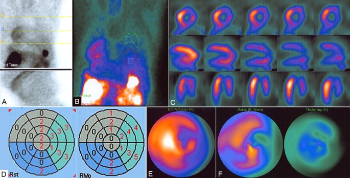 Assessment of Myocardial Viability Using Nuclear Medicine Imaging in  Dextrocardia