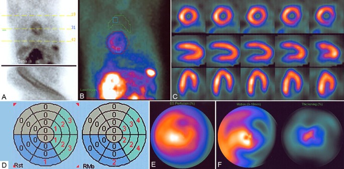 Assessment of Myocardial Viability Using Nuclear Medicine Imaging in  Dextrocardia