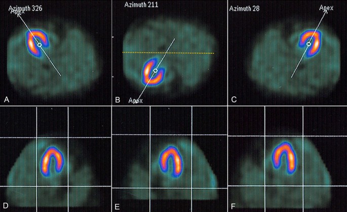 Assessment of Myocardial Viability Using Nuclear Medicine Imaging in  Dextrocardia