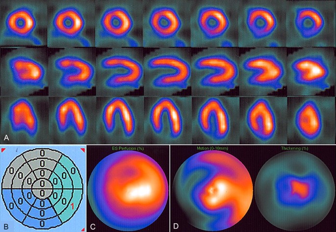 Assessment of Myocardial Viability Using Nuclear Medicine Imaging in  Dextrocardia