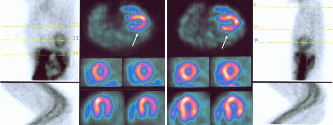 PDF) Comparison between 180° and 360° acquisition arcs with and without  correction by CT-based attenuation maps in normal hearts at rest