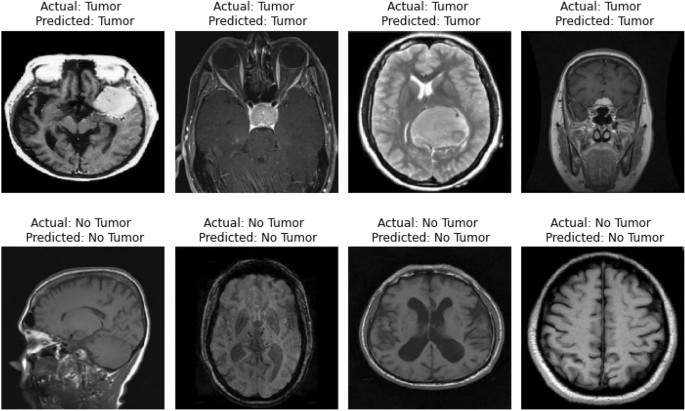 Leveraging Datature Nexus for Tumor and Anomaly Detection in Medical Scans  : Part I