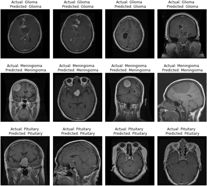 Leveraging Datature Nexus for Tumor and Anomaly Detection in Medical Scans  : Part I